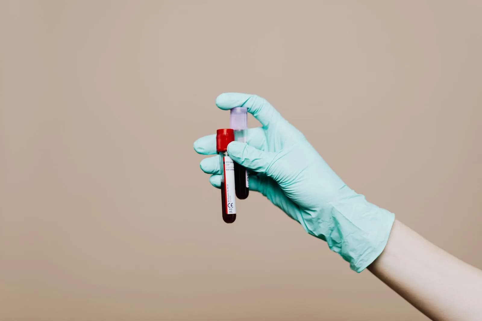 Gloved hand holding labelled blood test tubes for hair loss diagnosis