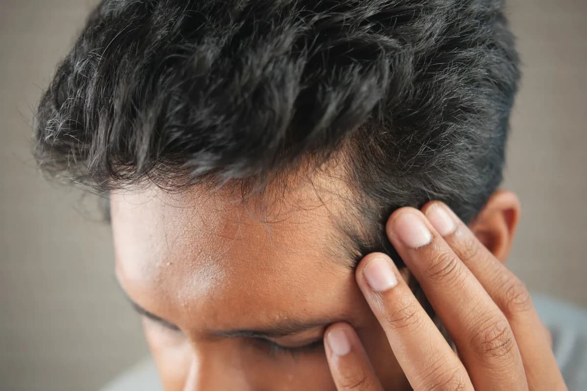 Crown thinning treatment Malta — close-up of a man's head showing vertex hair loss pattern
